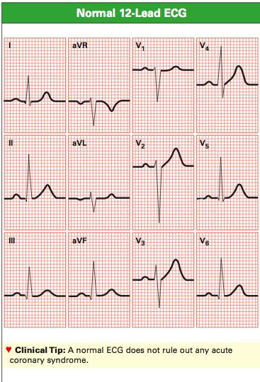 Normal 12 Lead Ecg Complexes Nursing Pinterest Cardiology