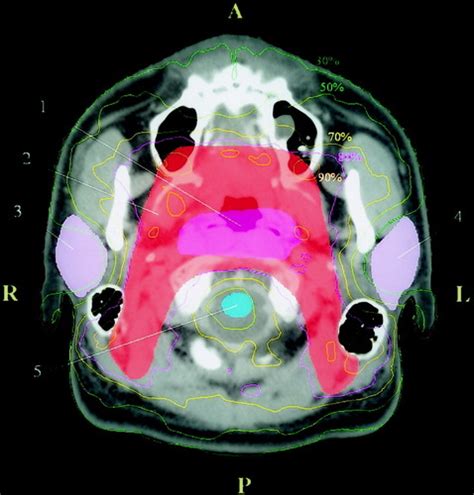 Intensity‐modulated Radiotherapy For Early‐stage Nasopharyngeal