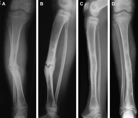Tibial Non Union A Review Of Current Practice Current Orthopaedics