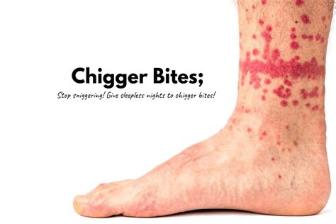 How To Treat Chigger Bites 10 Proven Natural Remedies How To Cure