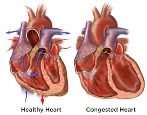 Certain conditions render the heart too stiff or weak to work to full capacity, such as high blood pressure or narrowed or clogged arteries. Congestive Heart Failure (CHF). Causes, symptoms ...