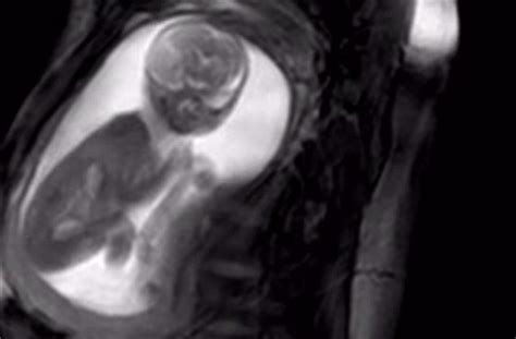 Amazing New 20 Week Mri Scan Shows Unborn Baby Wiggling And Swallowing