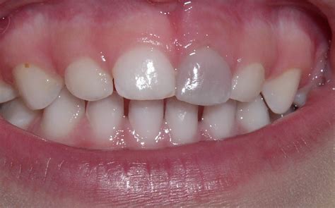 How To Remove Yellow Stains From Childs Teeth Liedketrautman