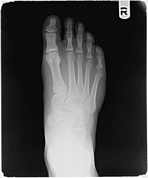 Intraosseous Lipoma The Foot And Ankle Online Journal