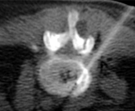 Biopsy Of The L45 Disc Using The Posterolateral Paravertebral Approach