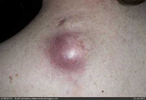Stock Image Infected Sebaceous Cyst On The Back A Sebaceous Cyst Also