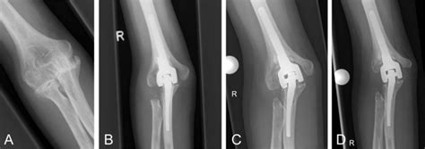 Long Term Results Of Total Elbow Arthroplasty In Patients With