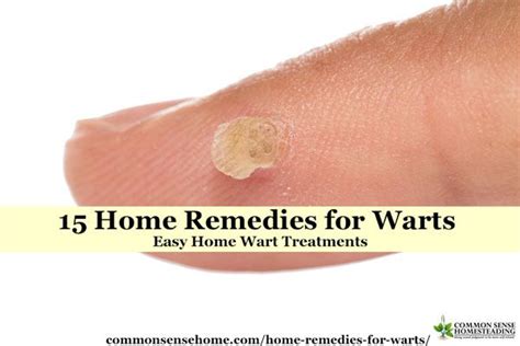 15 Home Remedies For Warts Easy Home Wart Treatments Home Remedies