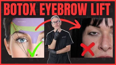 Best Botox Eyebrow Lift Injection Patterns Avoiding Spock Brow