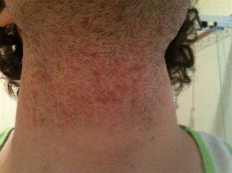 When I Shave My Neckbeard Area My Neck Ends Up Covered In Red Spots