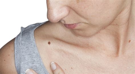 Skin Cancer Screenings Know What To Look For Luminis Health