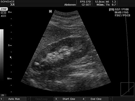 Ultrasound Images • Kidney B Mode Echogramm №402