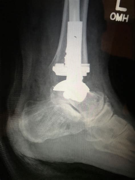 Total Ankle Arthroplasty With Custom Prosthetic Fibular Implantation