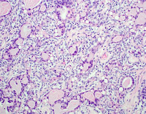 Pathology Outlines Epithelial Myoepithelial Carcinoma