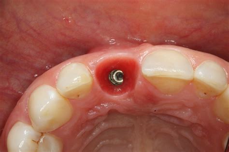Soft Tissue Thickening At Early Implant Placement And Gbr With Mucoderm