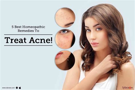 5 Best Homeopathic Remedies To Treat Acne By Dr K P Akbar Lybrate