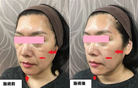 上 目の下のシワ 改善 美容皮膚科 350165 目の下のシワ 改善 美容皮膚科