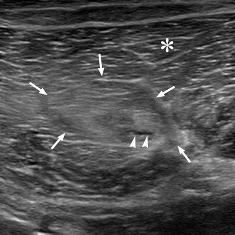 Imaging Of Muscle Injuries In Sports Medicine Sports Imaging Series