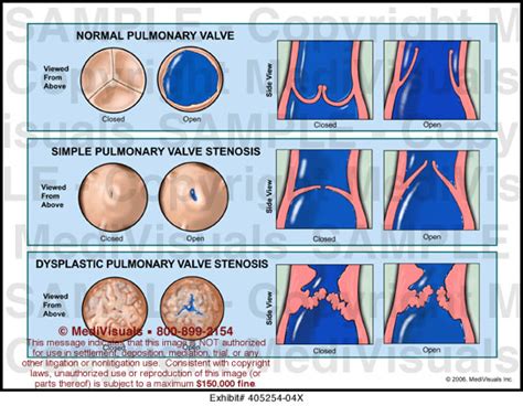Medivisuals Pulmonary Valve Medical Illustration