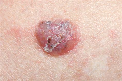 Nodular Basal Cell Skin Cancer Stock Image C0151237 Science