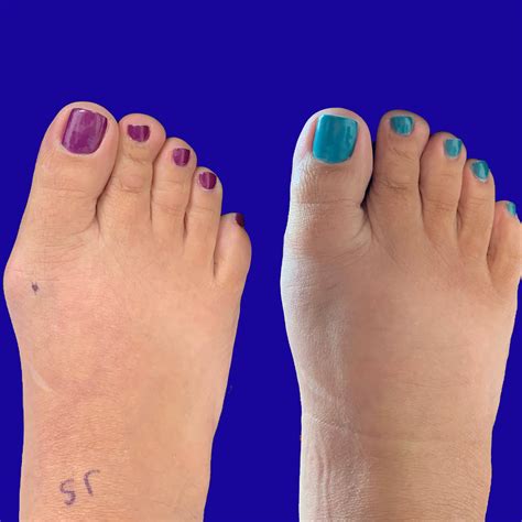 Before And After Bunion Surgery Photos Northwest Surgery Center