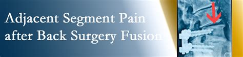 It remains controversial for treatment of axial pain secondary to degenerative disc disease. Groton Chiropractic Relief for Post-Fusion Adjacent ...