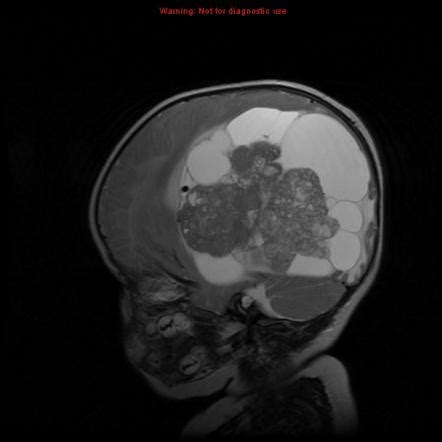 Choroid Plexus Carcinoma Image Radiopaedia Org
