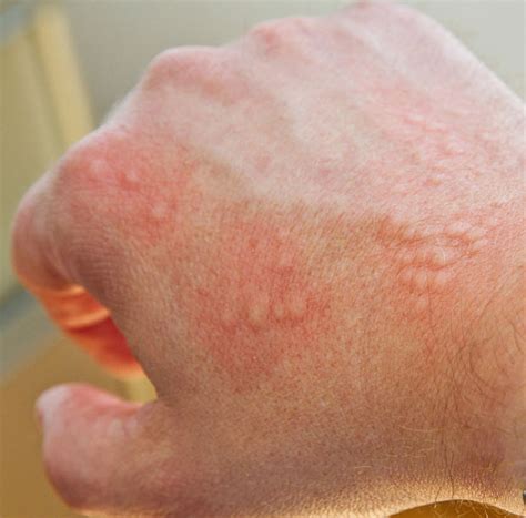 What Is A Skin Rash And How To Treat It Marietta Foot