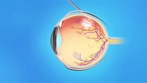 These areas, called retinal tears or retinal breaks, can lead to a retinal detachment. Ret Anim Torn Retina Cryopexy - YouTube