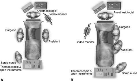 Single Port Video Assisted Thoracic Surgery Uniportal In The Routine