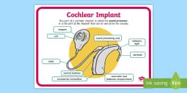 What Is A Cochlear Implant Answered Twinkl Teaching Wiki