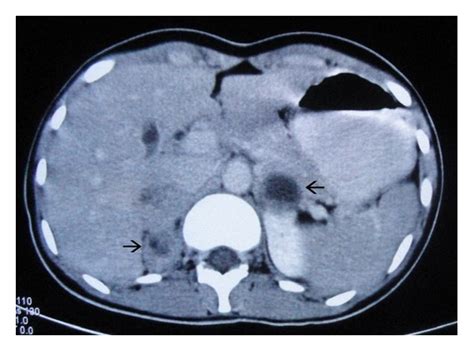 Axial Contrast Enhanced Ct Images Of Abdomen Taken At The Level Of
