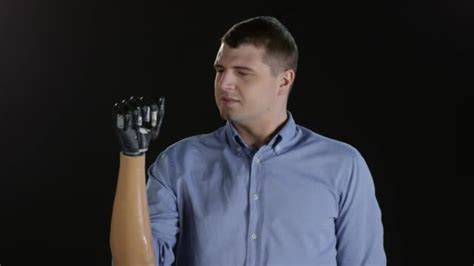 Amputee Man Moving Fingers On Prosthetic Arm Free Stock Video Footage