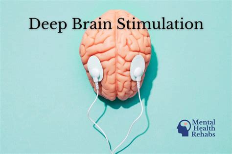 Deep Brain Stimulation Dms Mental Health Rehabs