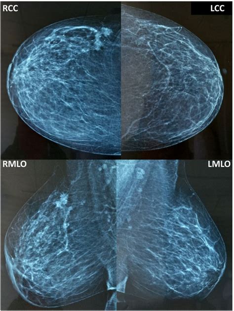 Patient 2 Mammogram Showing Spiculated Densities In The Upper Outer