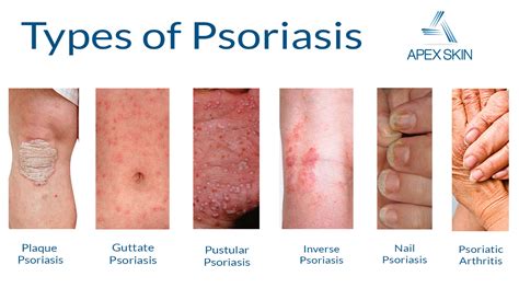 Psoriasis Types Chart