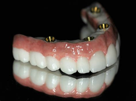 Full Mouth Dental Implants Minimalis