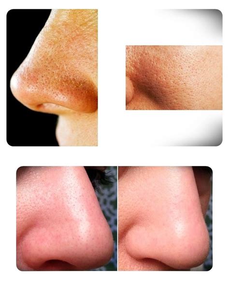 Get Rid Of Large Skin Pores Lady Inspired Tips Skin Natural