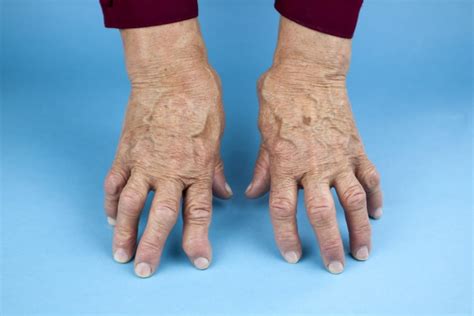 Rheumatoid Arthritis Here Are Five Early Warning Signs