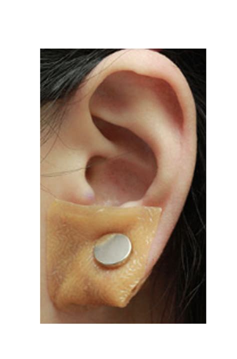 Earlums Blog Preventing The Recurrence Of Earlobe Keloids After