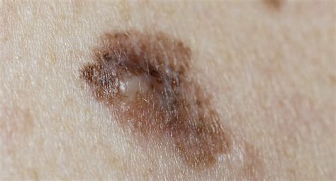 Melanoma treatment options include surgery, chemotherapy, radiation therapy, immunotherapy, and targeted therapy. Bilder på hudcancer (malignt melanom) | Cancerfonden