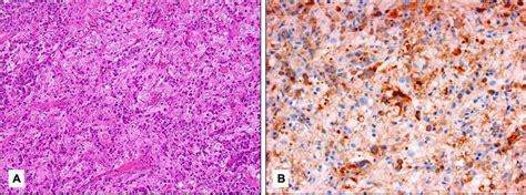 A Histopathology Of A Patient With Rosai Dorfman Disease Rdd With