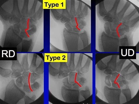 Fluoroscopic Images Of Wrist Type Lunate Wrist On The Top And Type Download Scientific