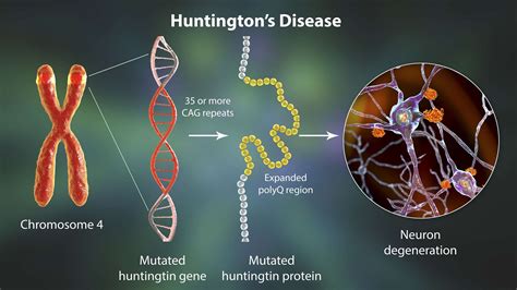 Huntingtons Disease Progression Stopped In Cell Study By University Of
