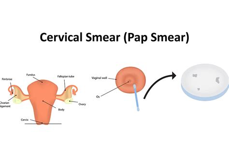 Pap Smear Test During Pregnancy Need Safety And Risks Associated