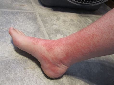 Red Rash On Feet And Swelling Prnso