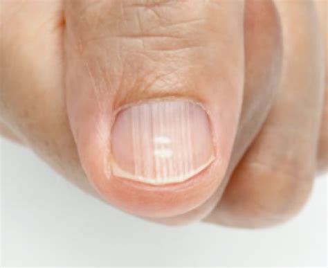 Vitamin d deficiency & skin problems. Vitamin Deficiency: Recognizing Signs & Symptoms ...