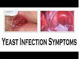 Photos of How Do Doctors Diagnose Yeast Infections