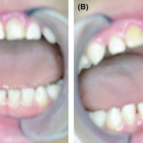 Pdf On Site Treatment Of Oral Ulcers Caused By Cheek Biting A