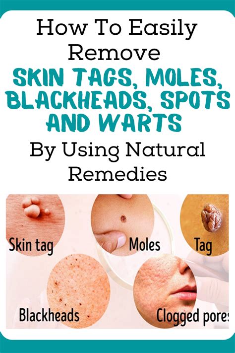 Photos Of Plantar Warts How To Remove Moles Warts Skin Tags Safely My